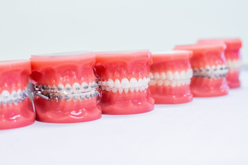 Types of braces on models