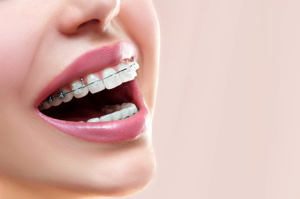 benefits of braces
